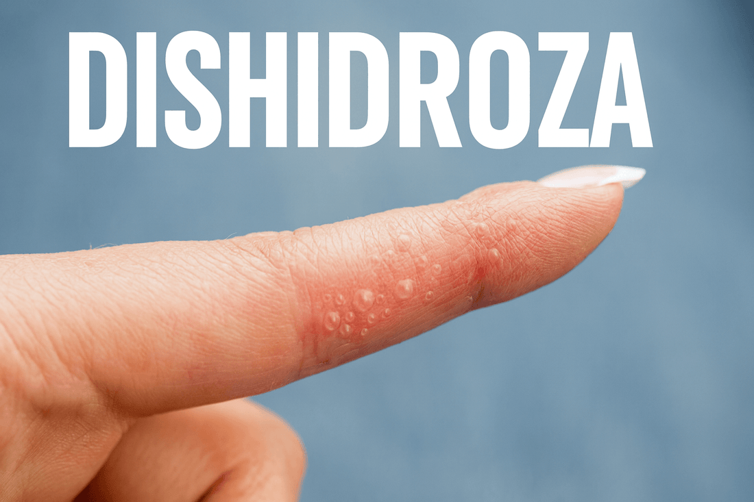 Dishidroza: Vse, kar morate vedeti (Posodobljeno 2025) - Skinfairytale